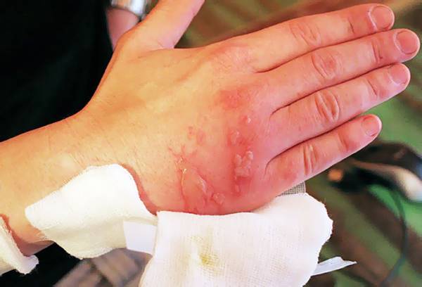 Chemische Verbrennung an der Hand