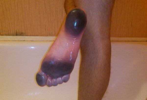 Der Fuß wurde durch den Schuh verfärbt