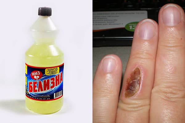 Verätzung am Finger durch Bleichmittel